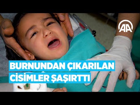 Burnundan çıkarılan cisimler şaşırttı