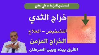 خراج الثدي| د علي بطيخ يشرح أسباب الخراج، والأعراض والعلاج، والخراج المزمن ولماذا يشتبه مع السرطان