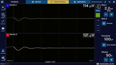 NIM Vital™ nerve monitoring system Set-up -  Quick Tags