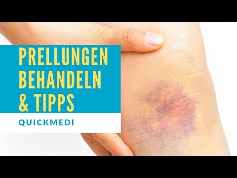 Video: Wo treten am häufigsten Prellungen auf?