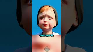 Çocuk Oyuncağı Yuttu Ama..