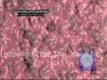 Colon Perforation video - Animation by Cal Shipley, M.D. Trial Image Inc.