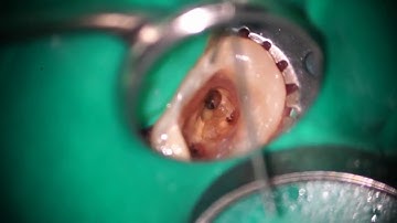 Broken file removal with ultrasonics after loosening it with an XP Shaper