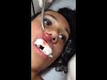 This woman has a swollen lip, what the doctor pulled out from it will shock you!