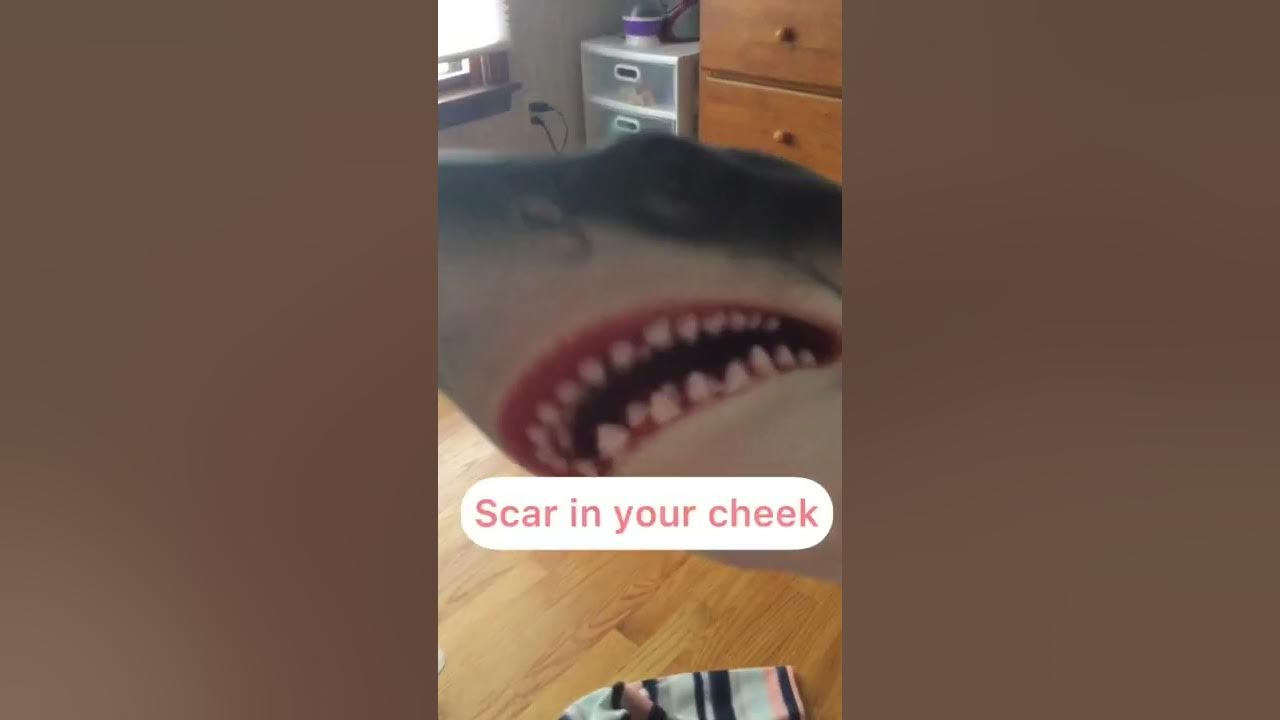 What happens when you accidentally bite the inside of your cheek YouTube