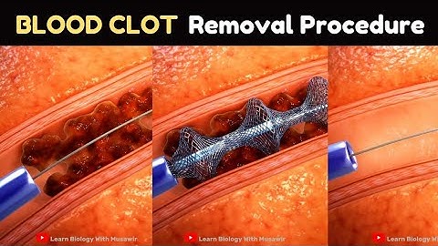 Procedure voor het verwijderen van bloedstolsels | Medische animatie
