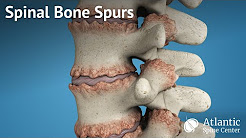 Spinal Bone Spurs