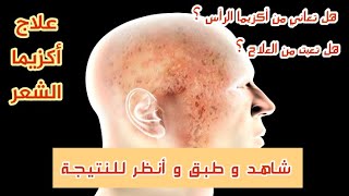 علاج أكزيما الشعر (Hair eczema treatment) 