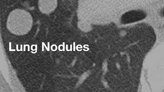 Lung Nodules (basics for patients)