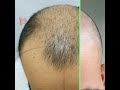 From dissatisfied to deliriously happy, Scalp Micropigmentation,  Lehigh Valley,  Philadelphia