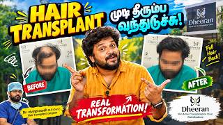 Natural Hair Transplant Result After 1.5 Years | Why He Returned for Crown Transplant | Coimbatore