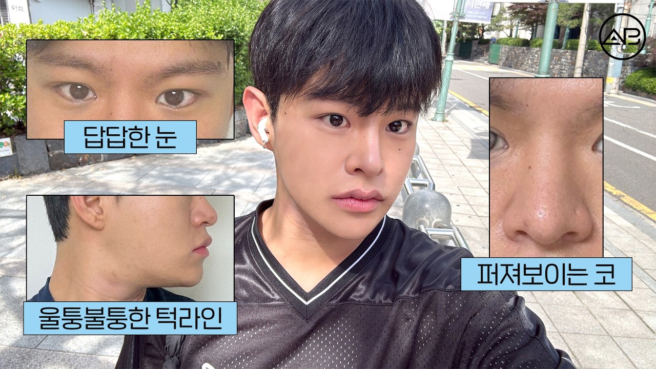 살쪄도 얼굴 작아 보이는 비결! 만족도 폭발한 남자 안면윤곽 찐후기 (붓기 대처법 및 보톡스 시기) | 비포애프터⭕| 에이비성형외과