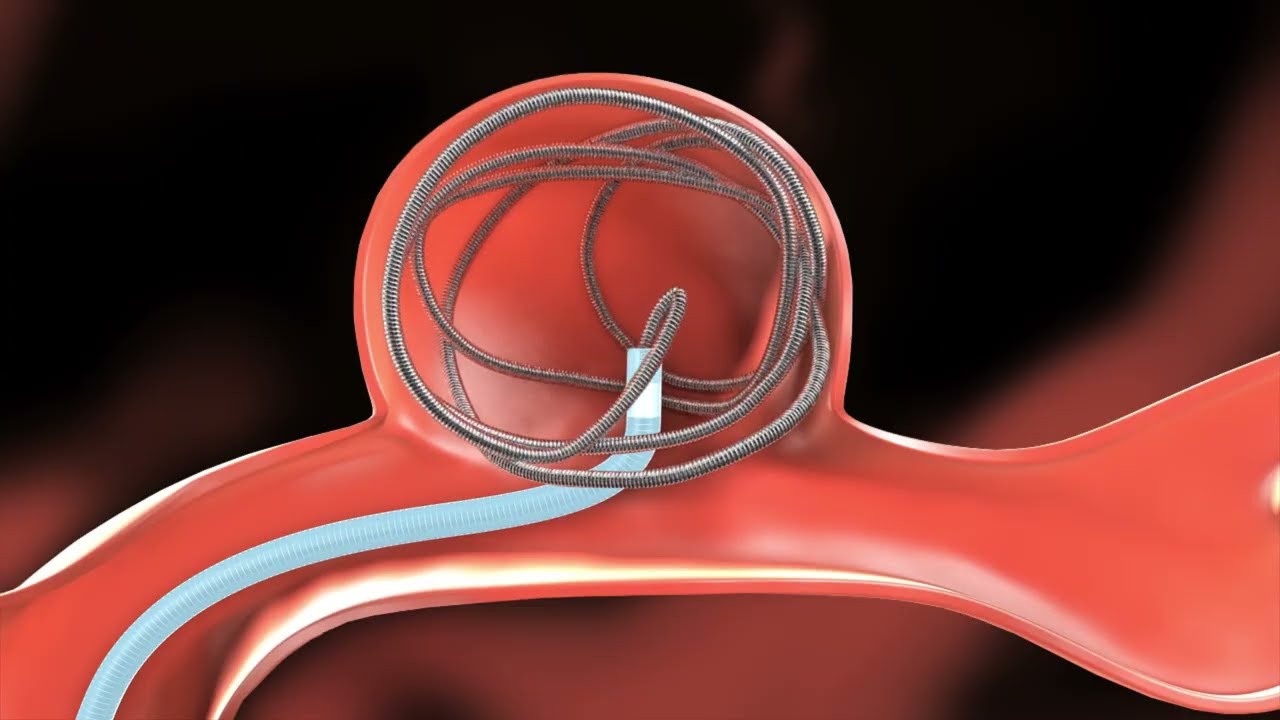 動脈瘤コイリング術