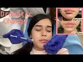 LIP FILLERS AT A YOUNG AGE | BEFORE & AFTER + WHOLE PROCEDURE