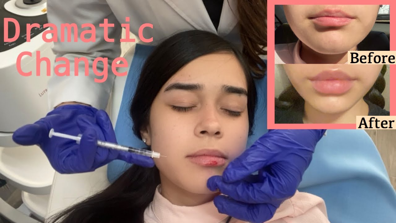 LIP FILLERS AT A YOUNG AGE | BEFORE & AFTER + WHOLE PROCEDURE