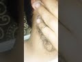 #asmrhair #satisfying #pimple #viralvideo #fypシ゚viral