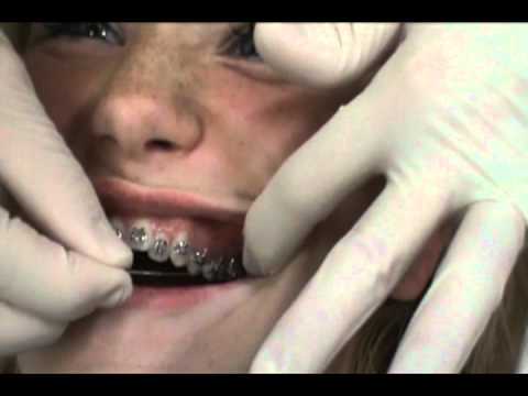Part 2: How are braces put on? Dr. Powell demonstr...