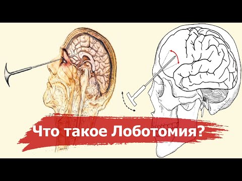 Лоботомия – кошмар 20 века | История самой ужасной операции