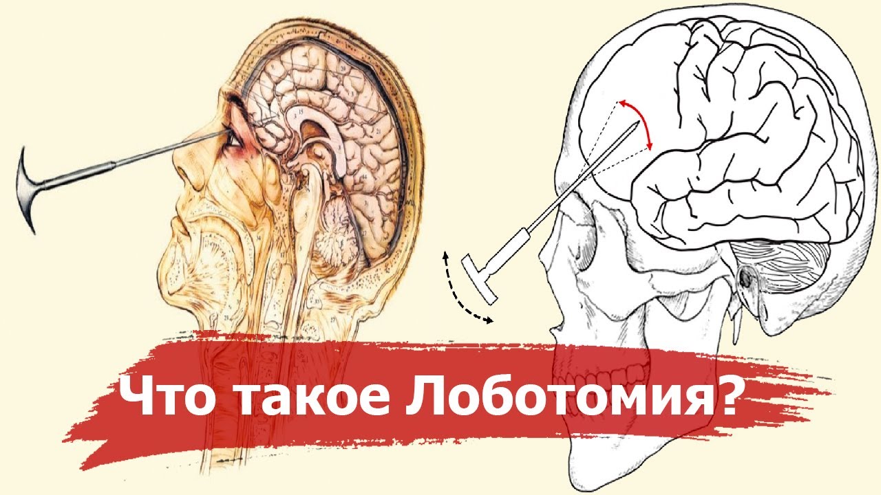 Лоботомия текст. Префронтальная Лоботомия. Трансорбитальная Лоботомия. Орбитокласт Лоботомия.