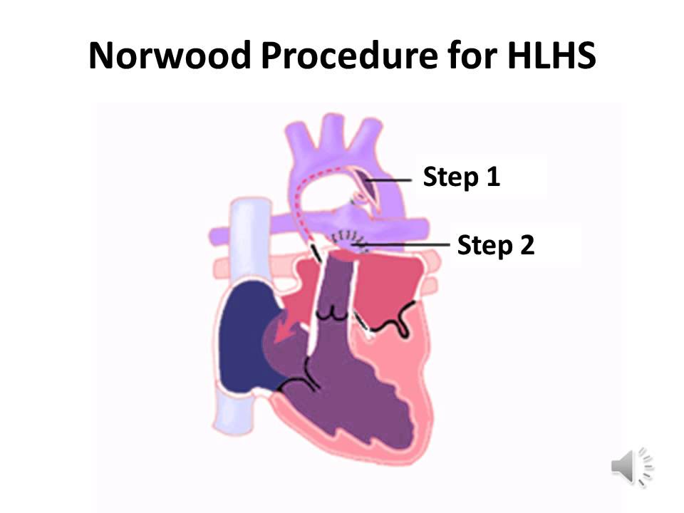 Norwood Procedure For Hypoplastic Left Heart Syndrome YouTube Norwood Procedure For Hypoplastic Left Heart Syndrome YouTube