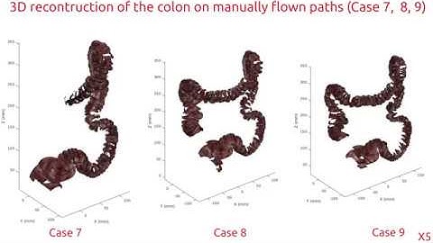 3D Reconstruction of Colon Structures and Textures from Stereo Colonoscopic Images