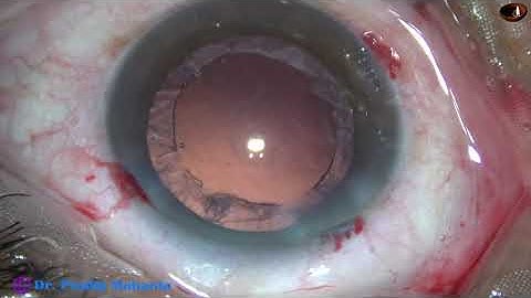 The "Stop and Chop" Technique of Phacoemulsification : Pradip Mohanta, 26th August, 2020