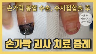 손가락 봉합 수술, 수지접합술 후 접합 부위 피부 괴사 치료 증례 모음