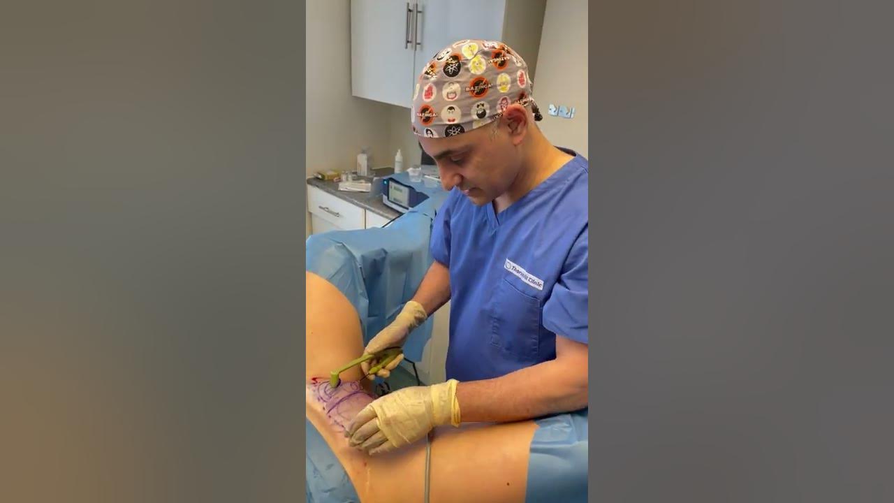 pubic-mound-tightening-with-labiaplasty-and-labia-majora-reduction-part
