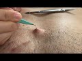 Popping huge blackheads and pimple popping  best pimple poppings 31
