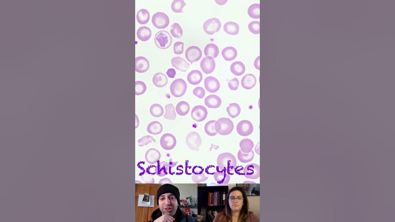 Echinocytes Acanthocytes
