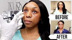 My Facial Plastic Surgery Experience + Live Footage!