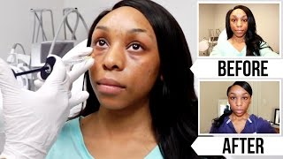 My Facial Plastic Surgery Experience + Live Footage!