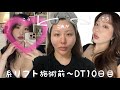 【整形のリアルVlog】糸リフトで若返り大作戦✨施術前・直後〜ダウンタイム10日目まで