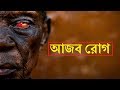 রুপকথার যে রহস্যময় রোগ গুলো বাস্তবেই পাওয়া গেছে। 4 Disease you wouldn't believe exist