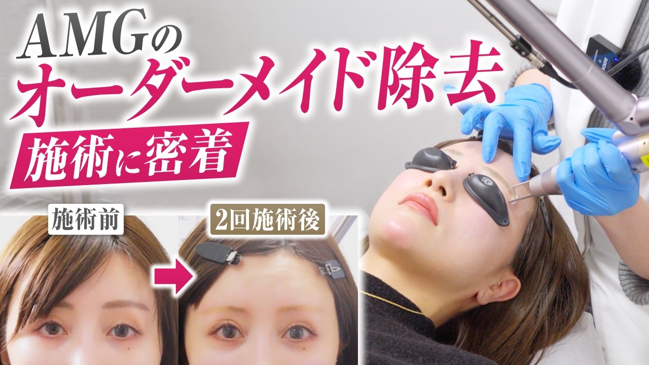 完全密着】6年前の眉アートメイクを除去したらこうなりました - YouTube