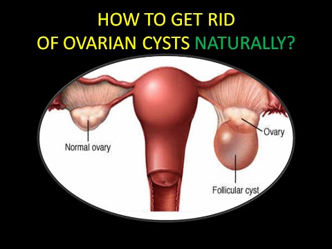 How To Get Rid Of Functional Ovarian Cysts Naturally How To Get Rid Of Functional Ovarian Cysts Naturally