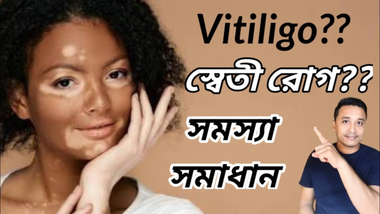 স্বেতী সমস্যার সমাধান 