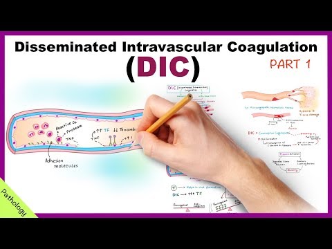 Video: Kada įvyksta diseminuota intravaskulinė koaguliacija?