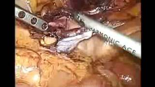 Inguinal Hernia Spigelian + sin. in women Biagio Orlandi MD Bari Italy