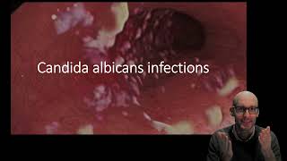 Candida albicans infections
