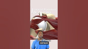 Latarjet Procedure #shorts