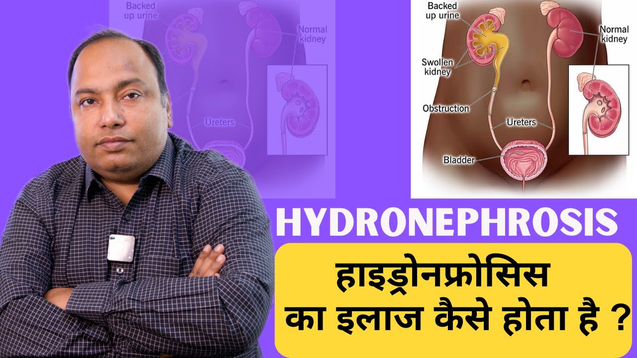 Hydronephrosis:  हाइड्रोनफ्रोसिस या क‍िडनी में सूजन क्या है जानिए इसका इलाज कैसे होता है ?