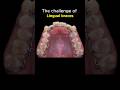 The challenge of lingual braces for crooked teeth #braces #dentist #orthodontics #fyp #asmr