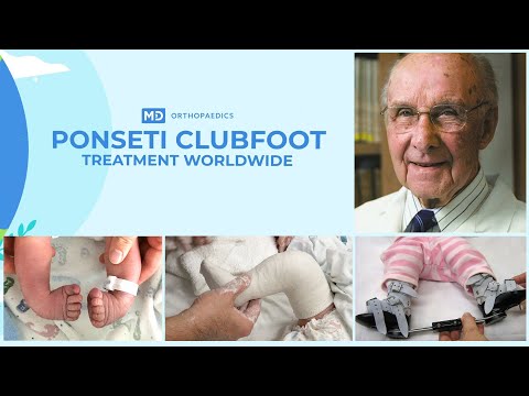 Ponseti Clubfoot Treatment Worldwide - Feature Length Documentary