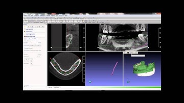 GuideMia Optical scan case basic workflow part1