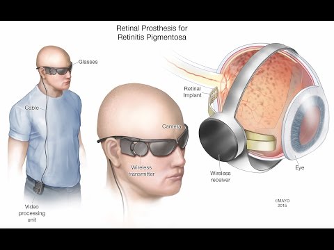 Retinal Prosthesis - Mayo Clinic