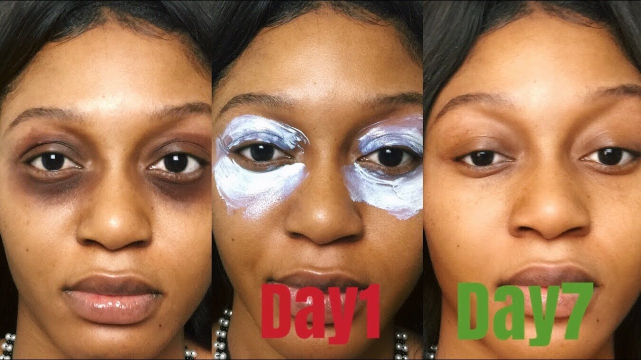 How To Get Rid Of Dark Circle Under Eyesor Dark Spots Fast Youtube