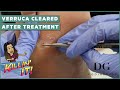 Verruca removal treatment with clearal results  | The Foot Scraper: DG Podiatrist