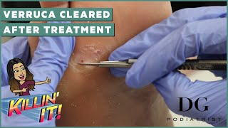 Verruca removal treatment with clearal results  | The Foot Scraper: DG Podiatrist