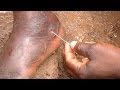 Eradicating Guinea Worm Disease: Taming the "Fiery Serpent" (Carter Center)